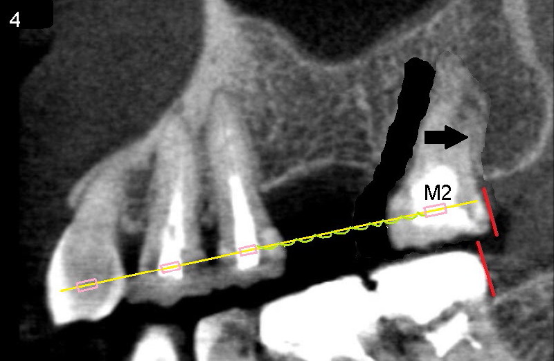 Braces Before Implant Design tooth shifts after neighboring tooth